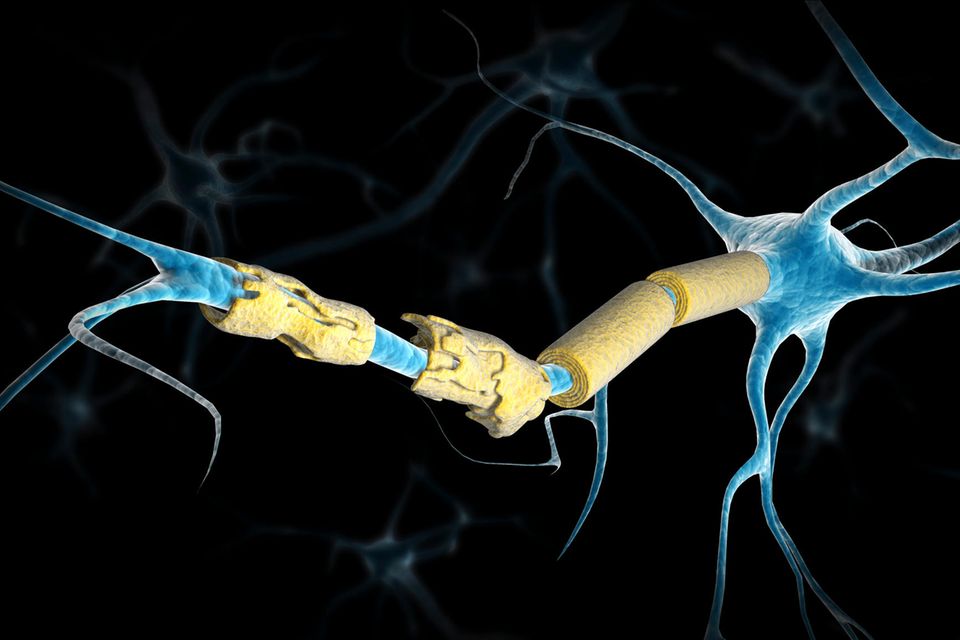 Illustration einer beschädigten Nervenzelle