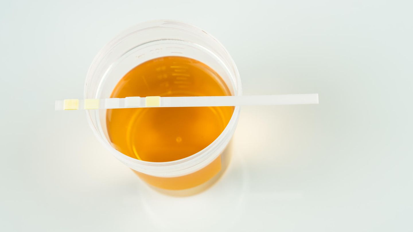 Die Farbe des Urins kann einiges über die Gesundheit aussagen