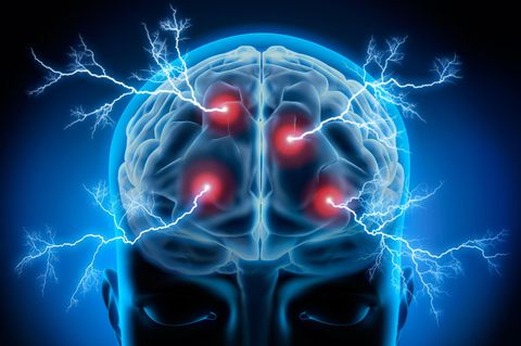 Die Elektrokonvulsionstherapie (EKT) mit dosierten Stromstößen löst einen Krampfanfall im Gehirn aus