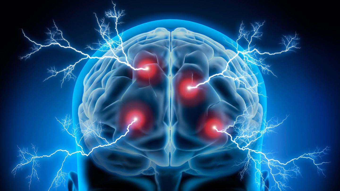 Psychische Gesundheit: Die Elektrokonvulsionstherapie (EKT) mit dosierten Stromstößen löst einen Krampfanfall im Gehirn aus Die Elektrokonvulsionstherapie (EKT) mit dosierten Stromstößen löst einen Krampfanfall im Gehirn aus