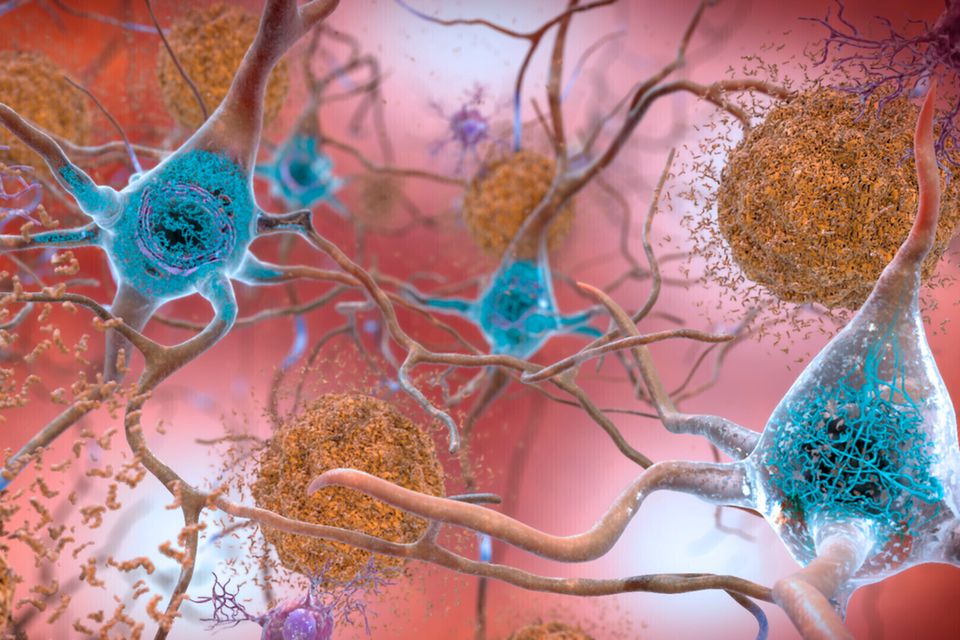 Zellen in von Alzheimer betroffenem Gehirn