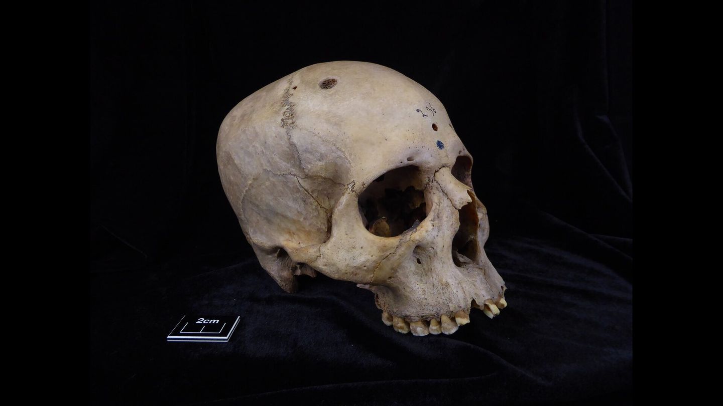 Dieser 4000 Jahre alte, altägyptische Schädel weist Krebs-Läsionen auf und zeigt mögliche Spuren eines chirurgischen Eingriffs
