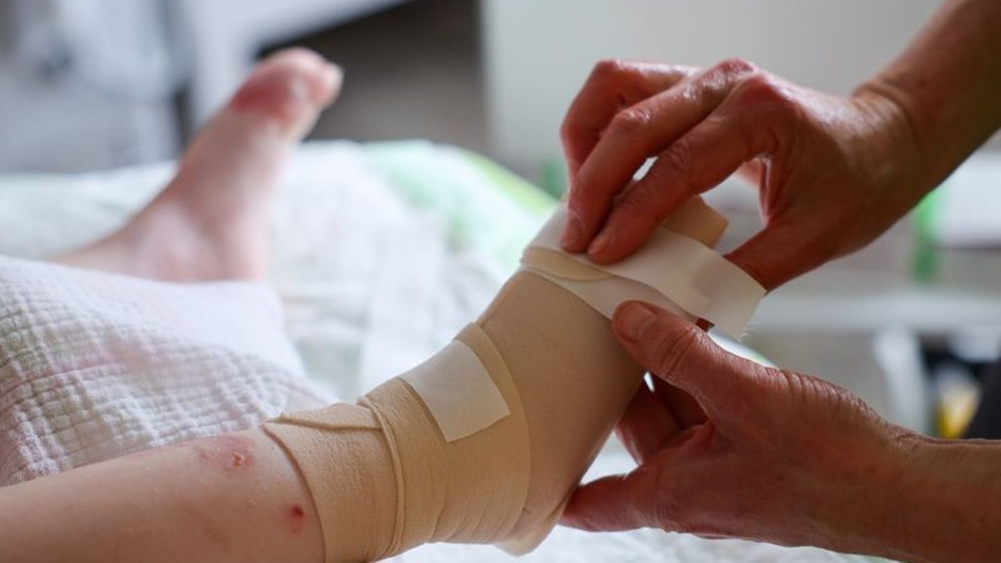 Käthe unterzieht sich dem täglichen, zweistündigen Verbandswechsel. Die Vierjährige leidet an Epidermolysis bullosa. Foto: Jan W