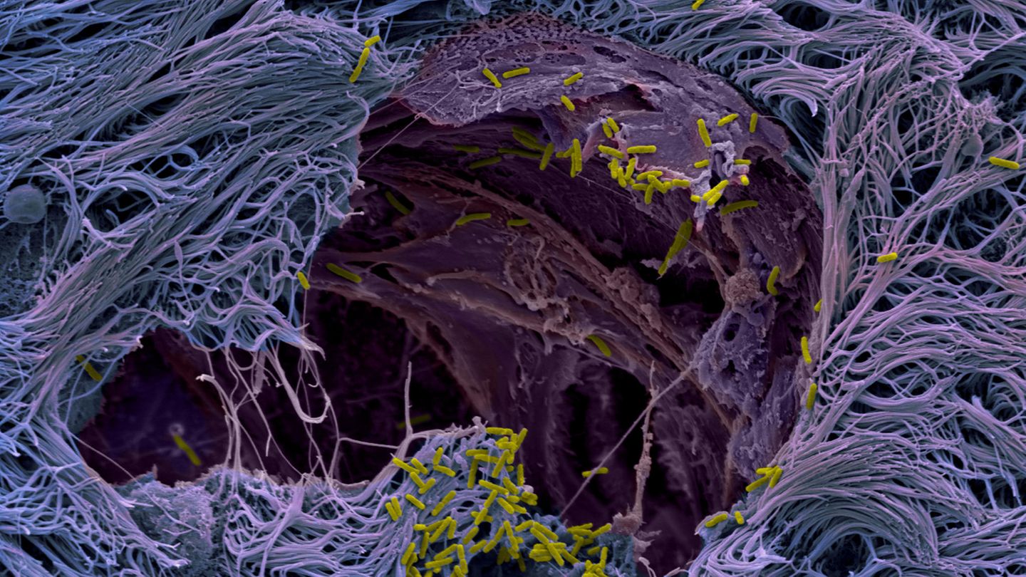 Mikroskopisch kleine Objekte lassen sich mit dem Rasterelektronenmikroskop abbilden. Es offenbart, wie der Krankenhauskeim Pseudomonas aeruginosa (grün nachkoloriert) nachgezüchtetes menschliches Lungenmikrogewebe (violett) durchdringt