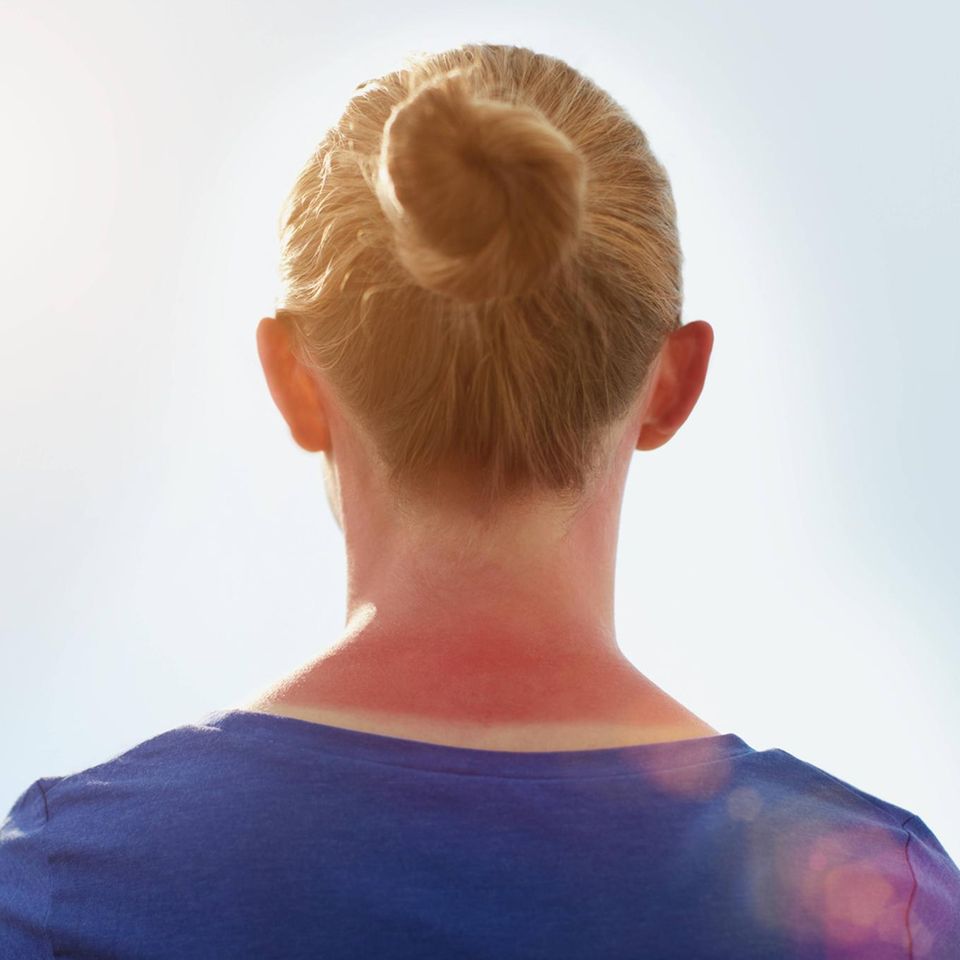 Frau mit Sonnenbrand