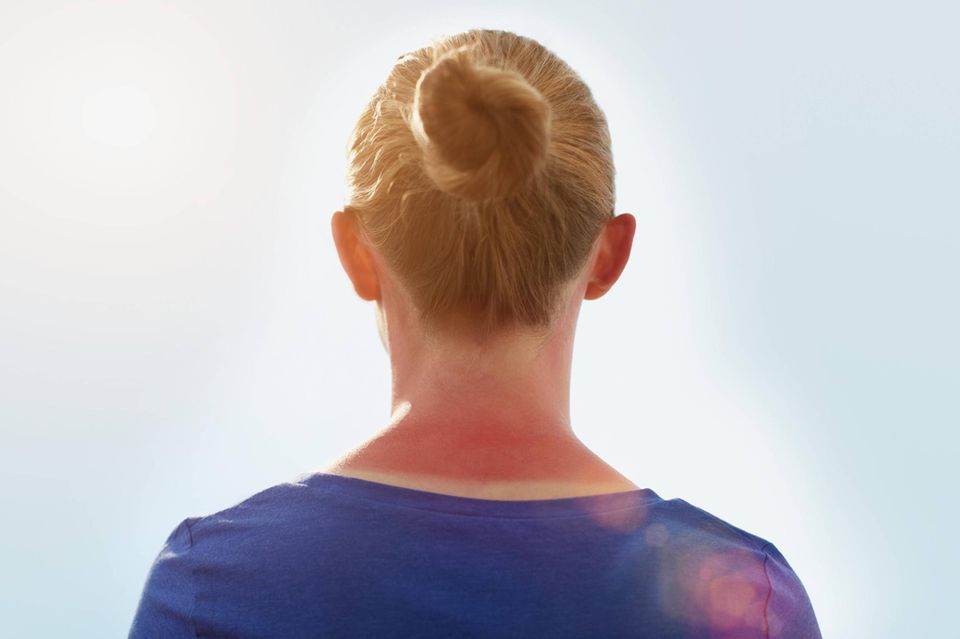 Frau mit Sonnenbrand 1.5004