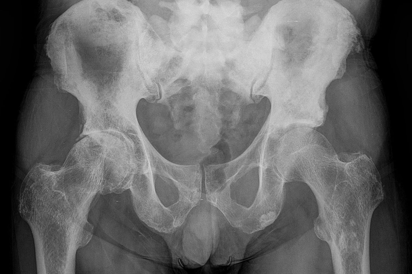 Multiple osteoplastische Knochenmetastasen bei einem Patienten mit Prostata-Karzinom