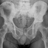 Multiple osteoplastische Knochenmetastasen bei einem Patienten mit Prostata-Karzinom