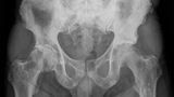 Multiple osteoplastische Knochenmetastasen bei einem Patienten mit Prostata-Karzinom