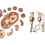 Schematische Darstellung eines Kaiserschnitts