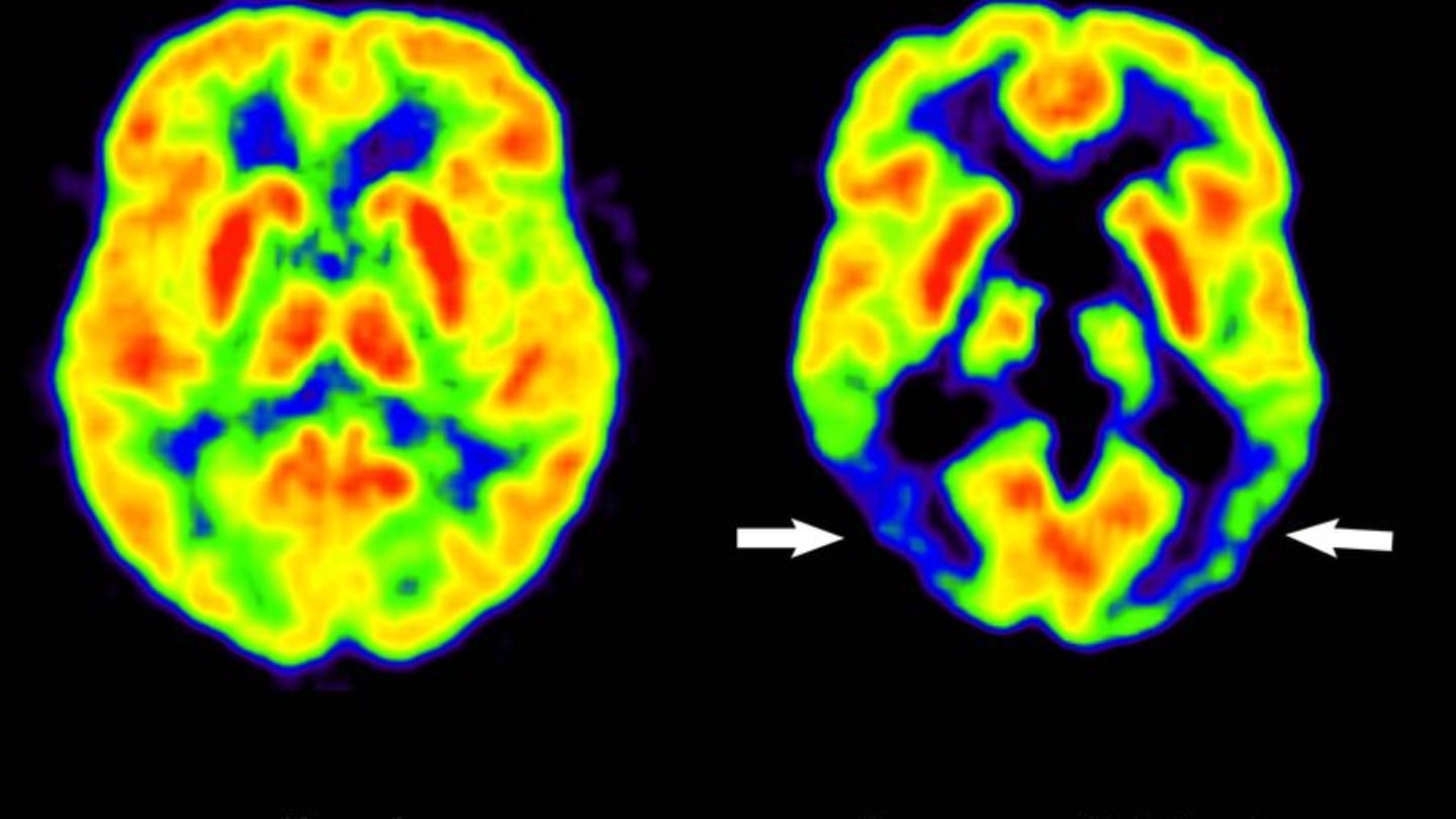 Alzheimer-Therapie in der EU: Entscheidung über Zulassung verzögert sich