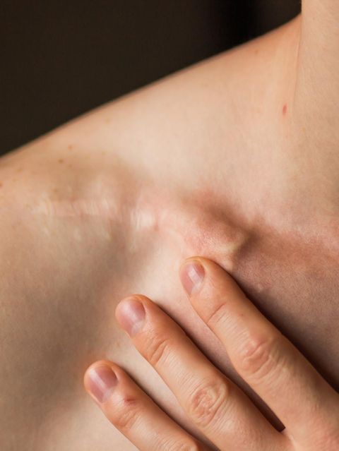 Ein Mann hält seine Hand an eine Narbe am Schlüsselbein