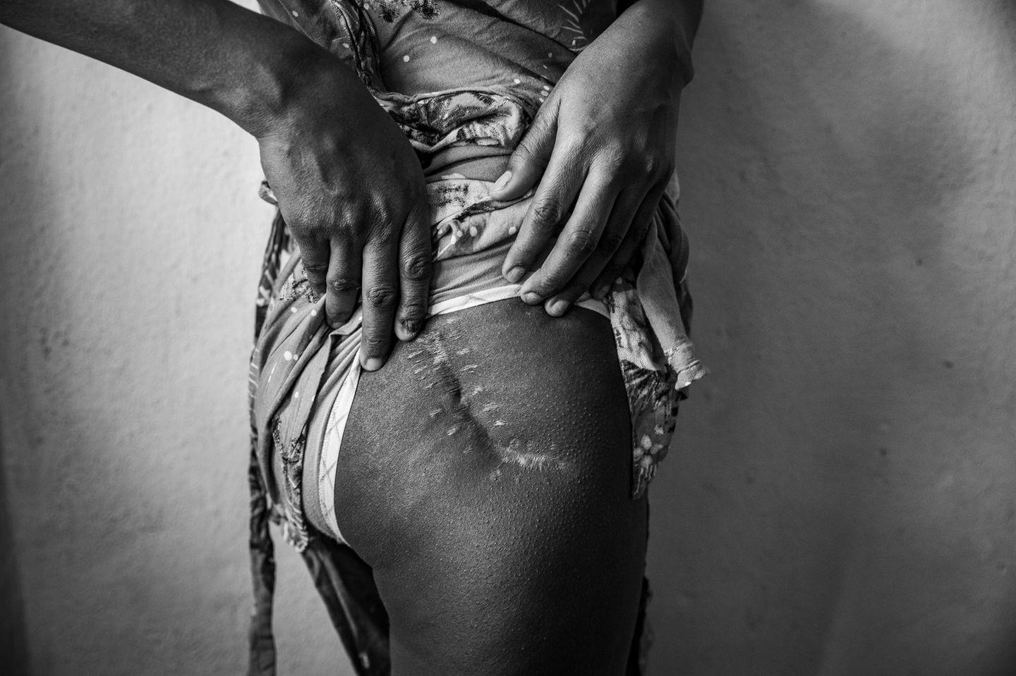 "Women's Bodies as Battlefields" von Cinzia Canneri Narbe am Oberschenkel einer eritreischen Geflüchteten
