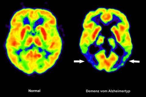 Lecanemab richtet sich gegen Amyloid-Ablagerungen im Gehirn und soll dadurch den Verlauf der Krankheit ein wenig verlangsamen