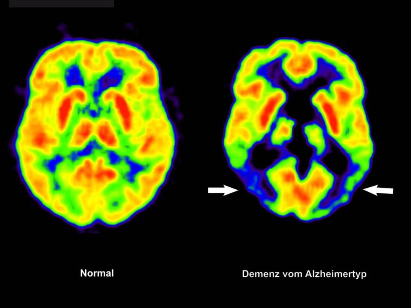 Lecanemab richtet sich gegen Amyloid-Ablagerungen im Gehirn und soll dadurch den Verlauf der Krankheit ein wenig verlangsamen