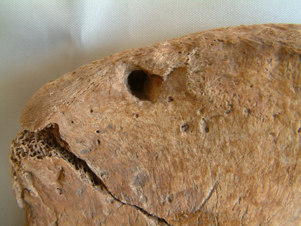 Knochen zeigt runde Verletzung