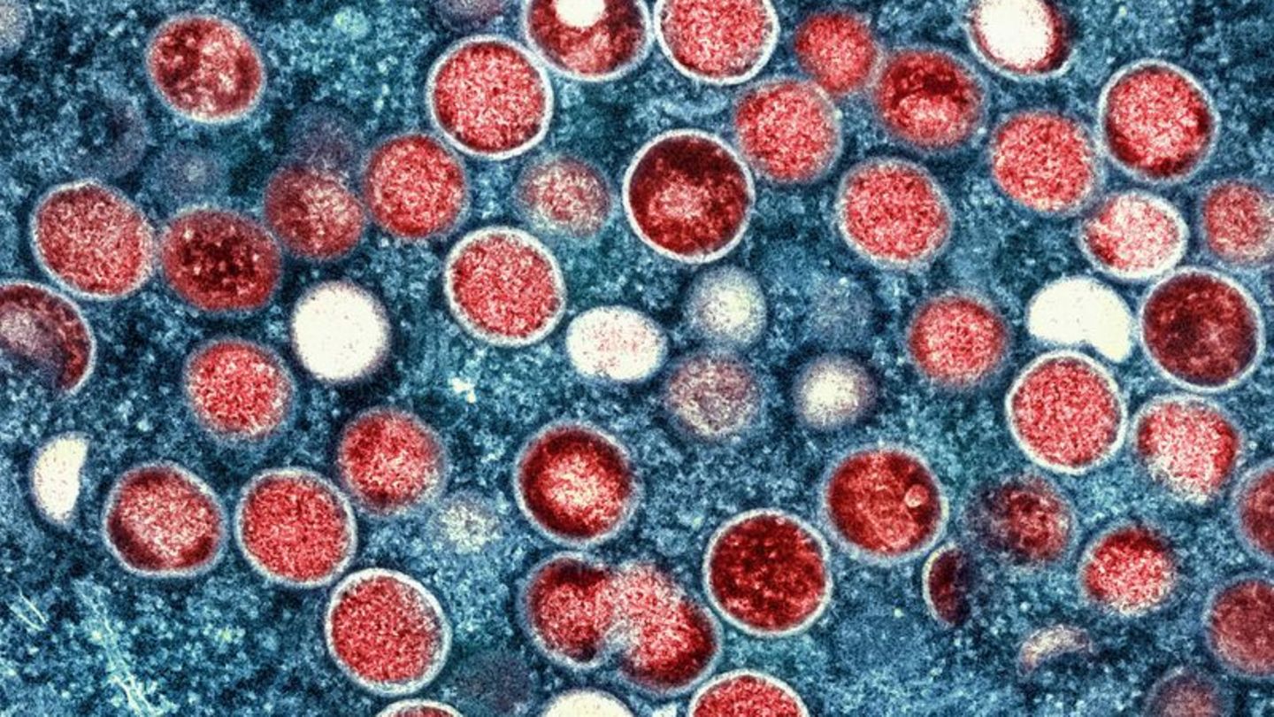 Krankheiten-Mehr-F-lle-von-Mpox-aber-Experte-bislang-gelassen