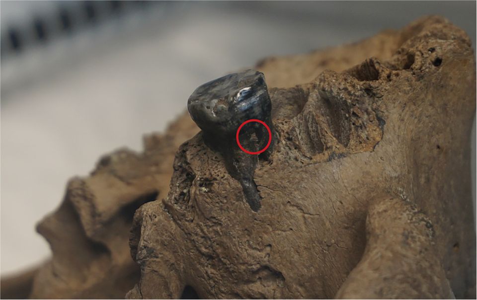 Aus dem Zahnstein dieses Zahns im Oberkiefer isolierten die Forschenden um Fu DNA, die sie dem Denisova-Menschen zuordnen konnten