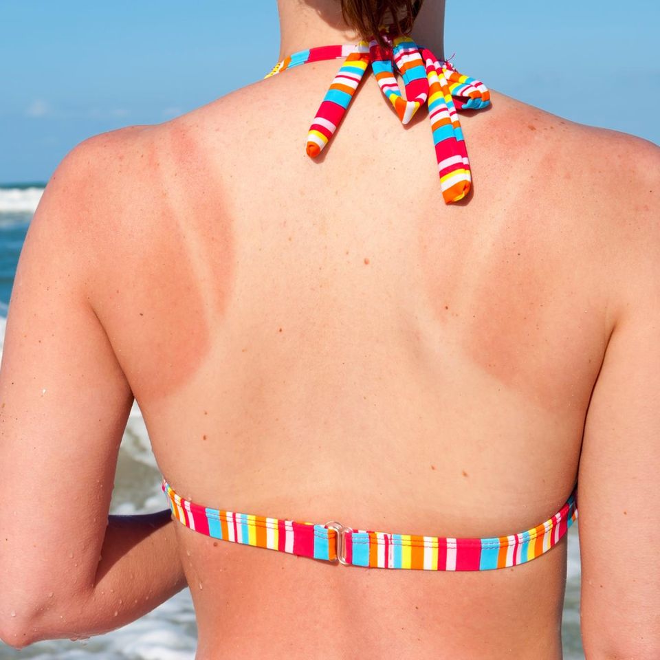 Frau am Meer mit Sonnenbrand im Bikini von hinten