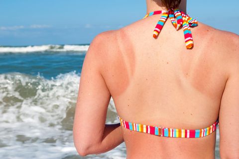 Frau am Meer mit Sonnenbrand im Bikini von hinten