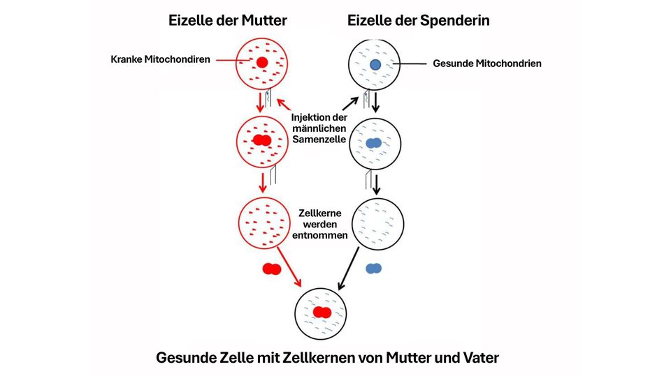 Die Mitochondrien-Ersatztherapie: So läuft sie ab.