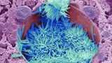 Cholesterinkristalle (blau) in einer mit Lipiden beladenen Leberzelle (violett) aus einer menschlichen Leber