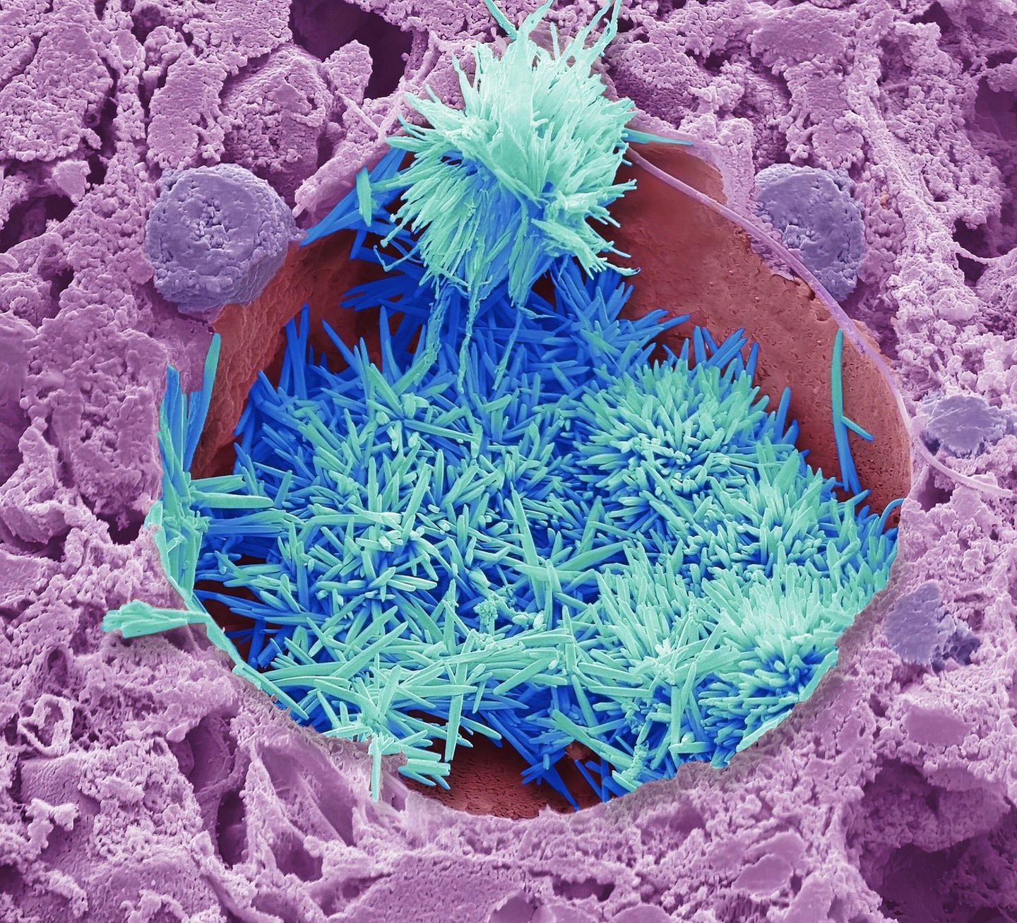 Cholesterinkristalle (blau) in einer mit Lipiden beladenen Leberzelle (violett) aus einer menschlichen Leber