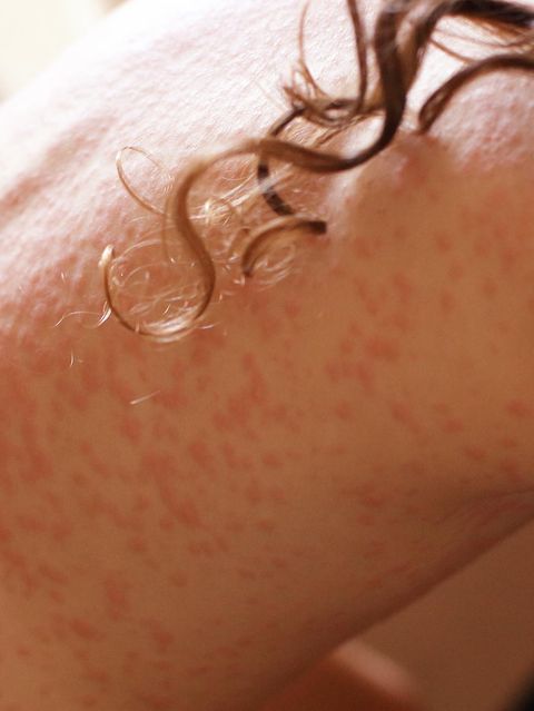 Heftiger Hautausschlag auf dem Rücken eines Mädchens