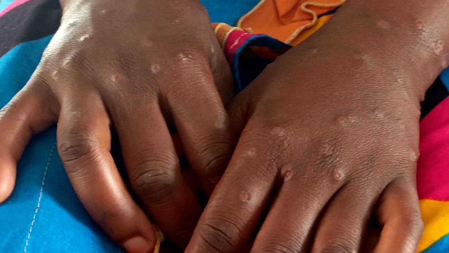 Krankheiten-Internationale-Notlage-wegen-Mpox-aufgehoben