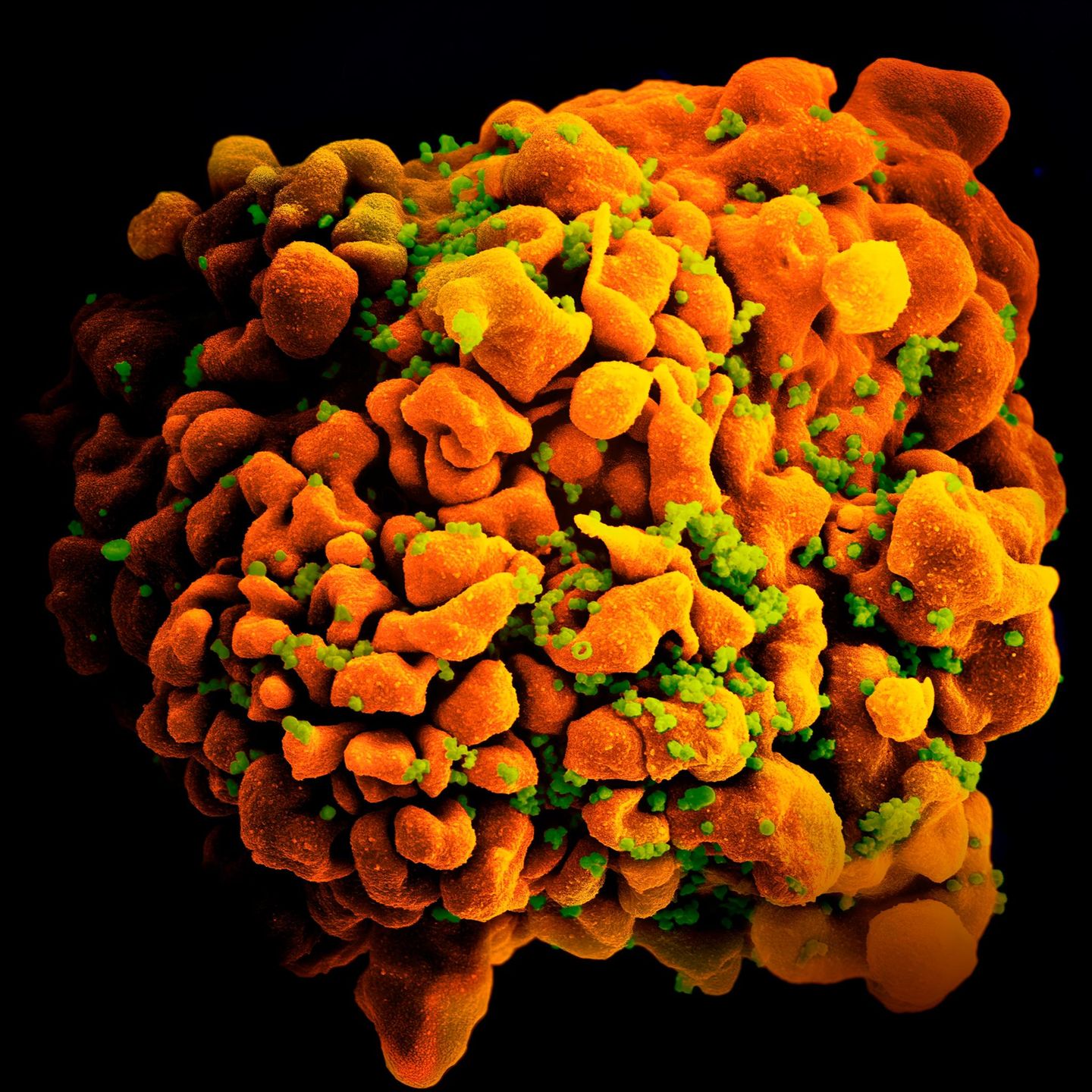 Elektronenmiskropische Aufnahme einer infizierten T-Zelle, orange-gelb und grün (HI Virus) eingefärbt