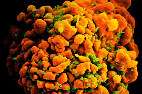 Elektronenmiskropische Aufnahme einer infizierten T-Zelle, orange-gelb und grün (HI Virus) eingefärbt