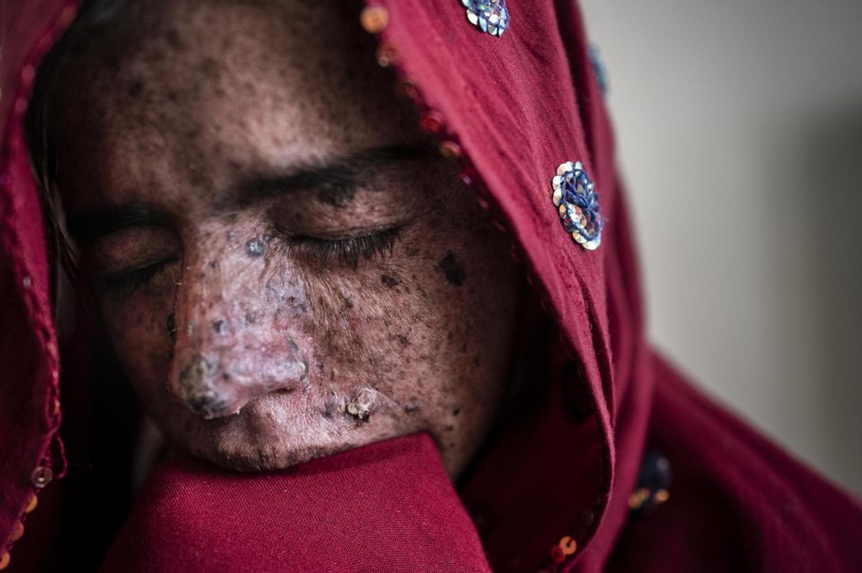 Ein Kind mit der sogenannten Mondscheinkrankheit