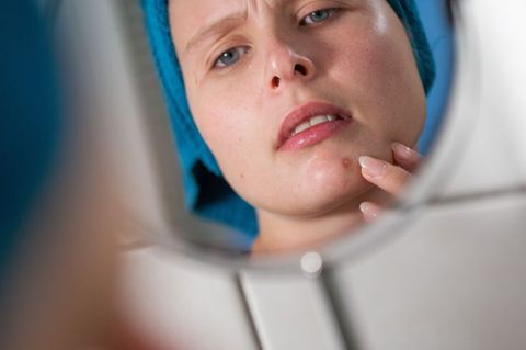 Mist, ein Pickel! Durch vermehrte Talgproduktion können Poren verstopfen und sich entzünden. Das stört viele nicht nur optisch,