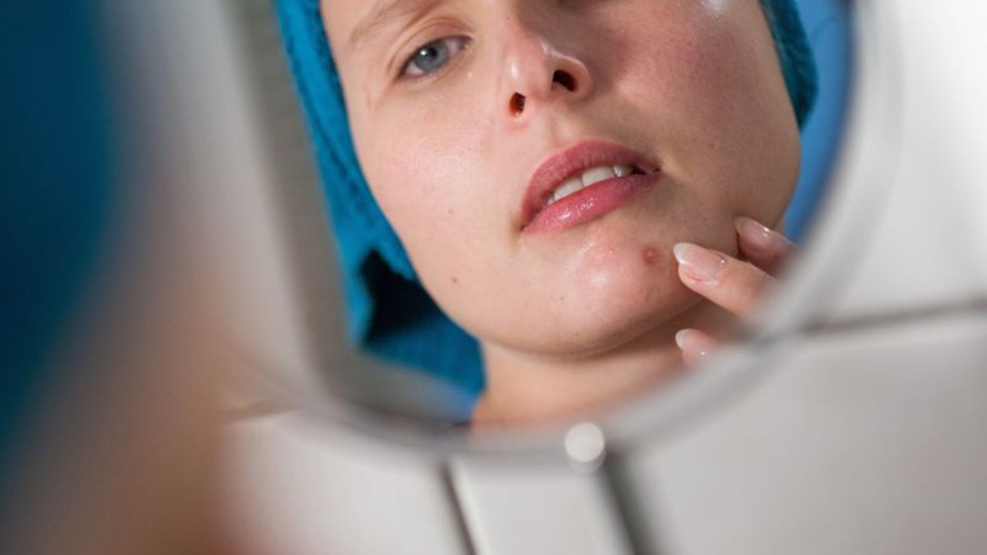 Mist, ein Pickel! Durch vermehrte Talgproduktion können Poren verstopfen und sich entzünden. Das stört viele nicht nur optisch,