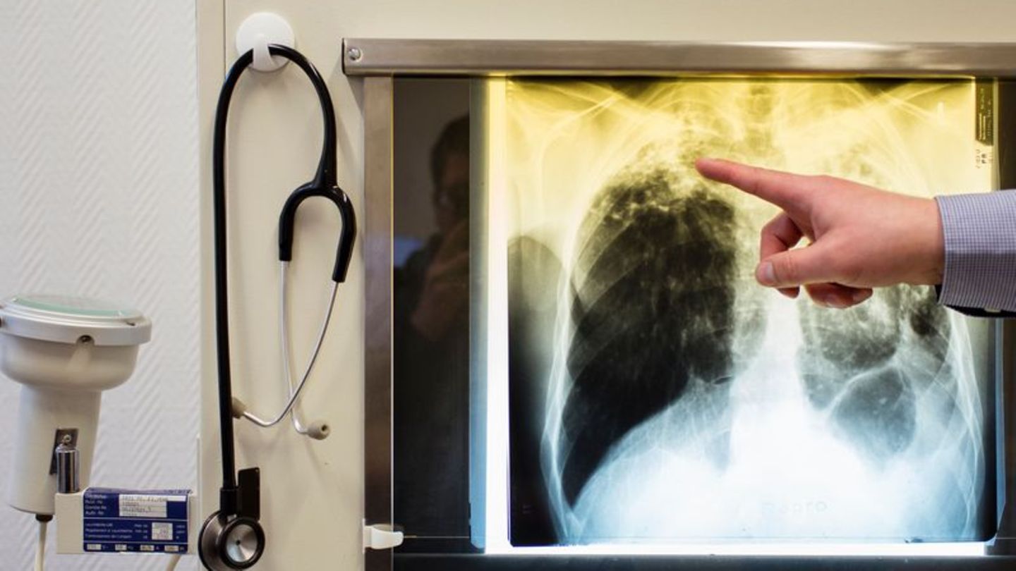 Tuberkulose-Erkrankungen werden in Europa oft nicht erkannt. (Illustration) Foto: Gregor Fischer/Deutsche Presse-Agentur GmbH/dp