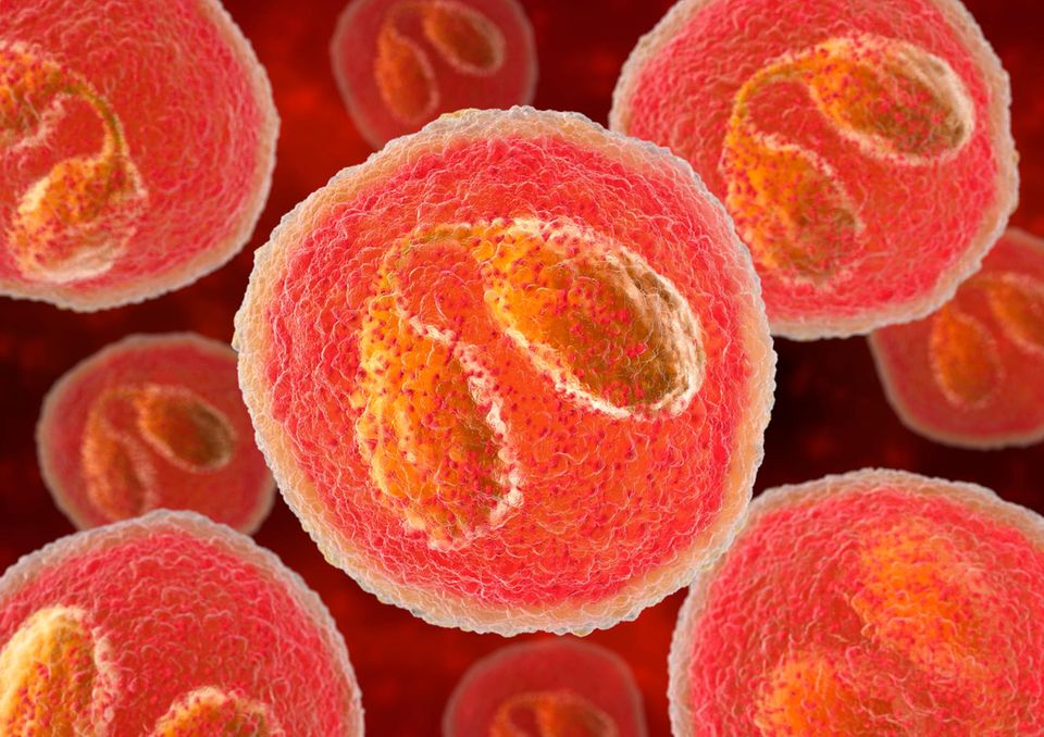 Eosinophile Granylozyten gehören zu den weißen Blutkörperchen (Leukozyten). Orange sind ihre charakteristisch segmentierten Zellkerne zu erkennen. Werden Eosinophile aktiviert, setzen sie mit toxischen Stoffen gefüllte Bläschen frei, meist um Parasiten abzuwehren. Bei stressbedingter Neurodermitis können sie auch das körpereigene Gewebe schädigen