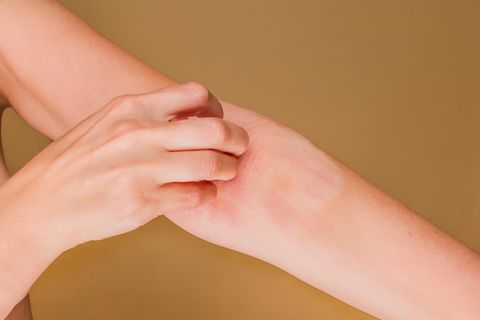 Eine Frau kratzt sich den geröteten Arm