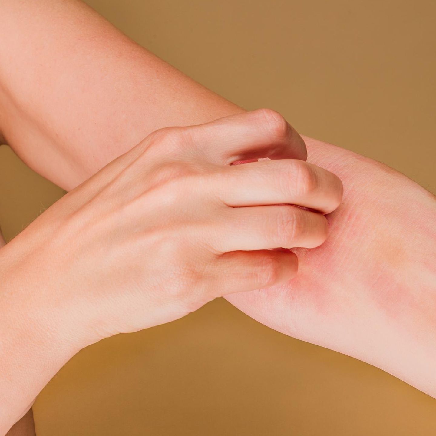 Eine Frau kratzt sich den geröteten Arm