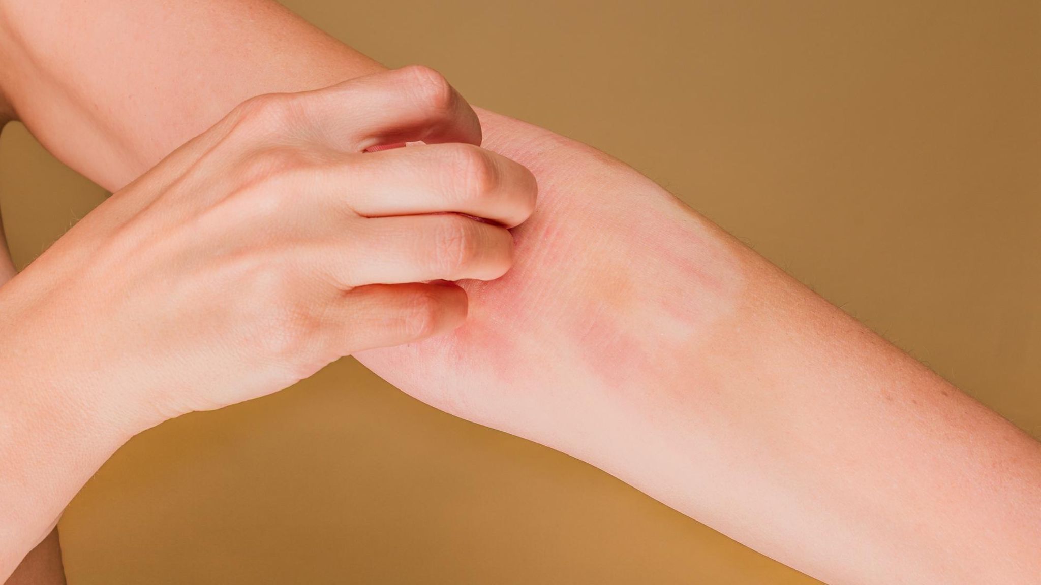 Eine Frau kratzt sich den geröteten Arm