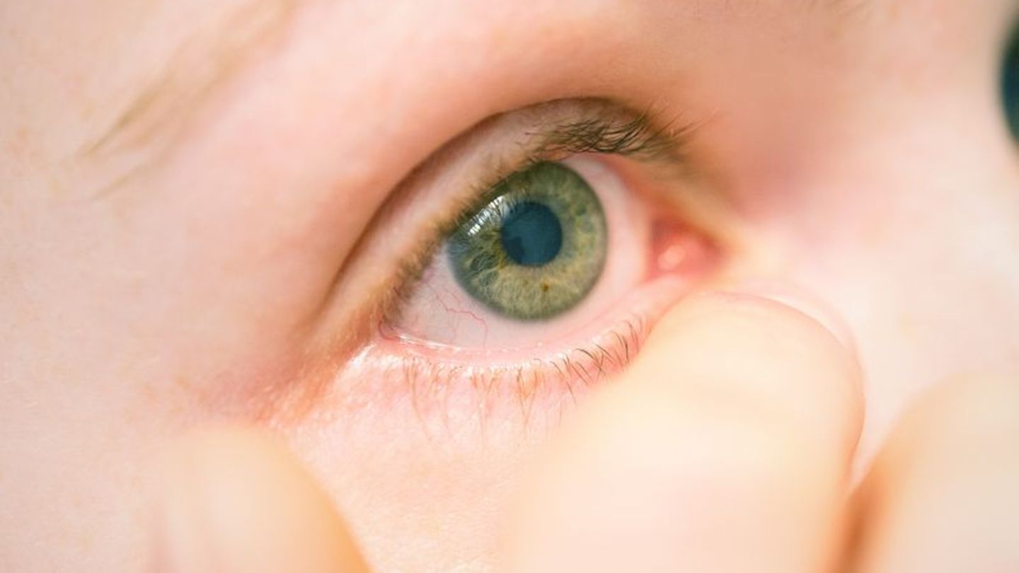 Nicht rumdrücken, lieber beraten lassen: Bei stärkerer Entzündung kann eine antibiotische Augensalbe nötig sein – abklären in Pr