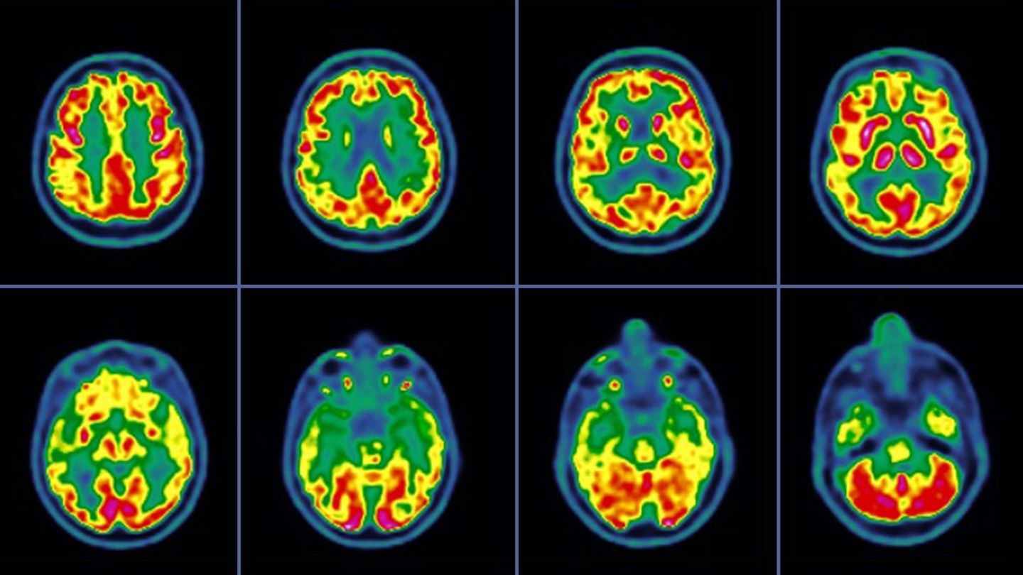 Gen-Analysen-Bislang-gr-te-Alzheimerstudie-wirft-neues-Licht-auf-Hirnentz-ndungen